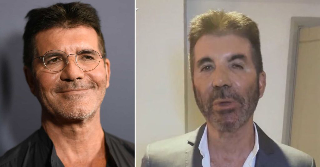 Simon Cowell do “Got Talent” aparece com a cara deformada!