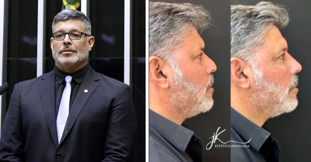 NOVO ROSTO! Alexandre Frota realiza harmonização facial